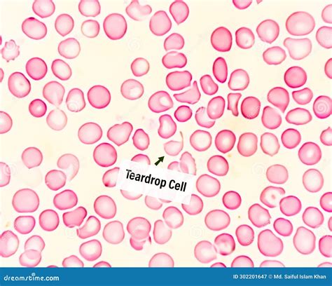 tear cells blood test|tear cells in bone marrow.